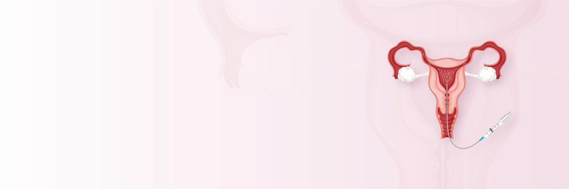 Affordable IUI Treatment with High Success Rates