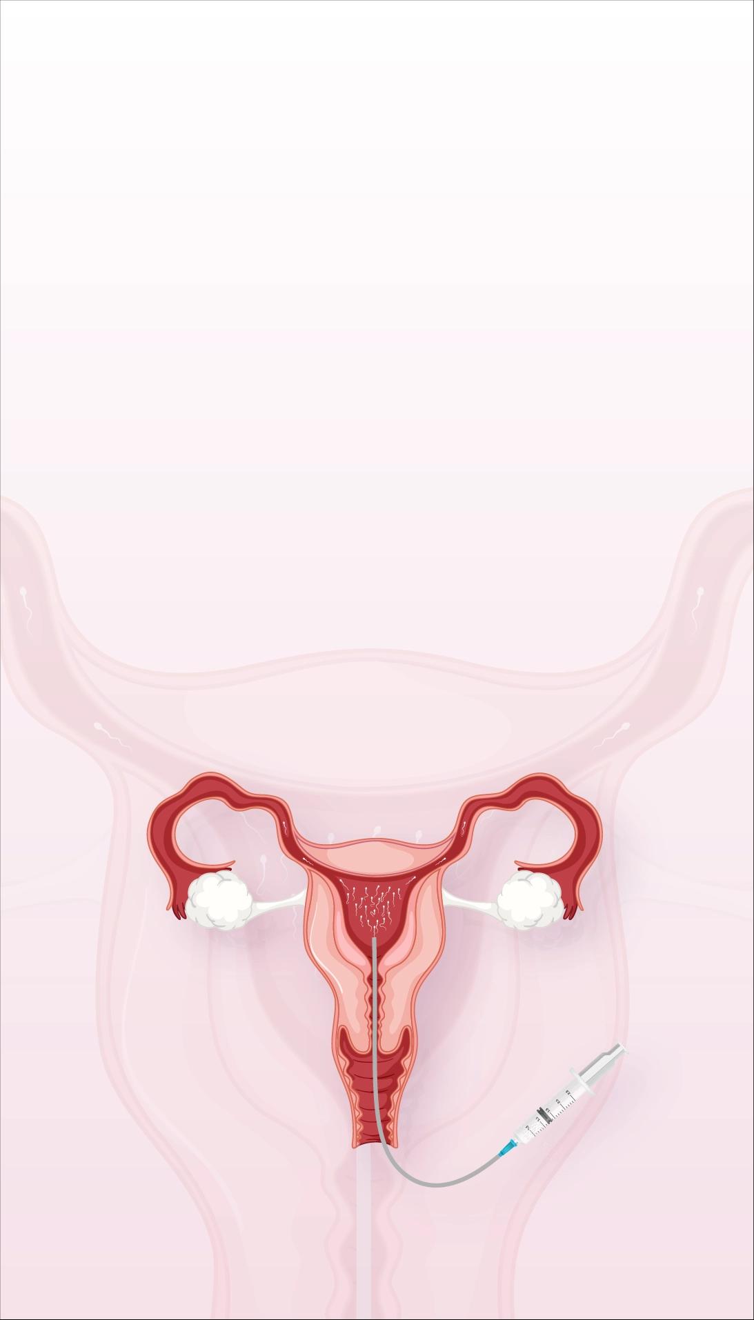 iui-intra-uterine-insemination