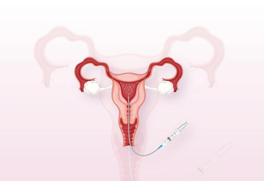 iui-intra-uterine-insemination