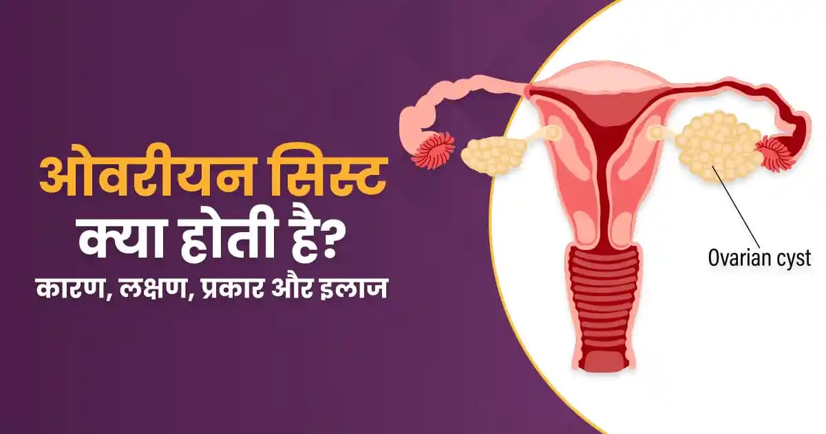 ओवरीयन सिस्ट क्या होती है? सिस्ट के कारण, लक्षण, प्रकार और इलाज image