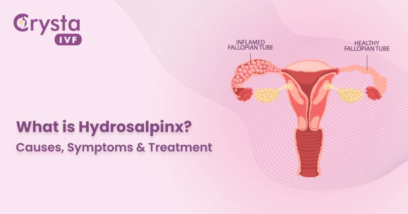 Hydrosalpinx Meaning: Causes, Symptoms & Treatment image
