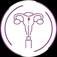 Intrauterine insemination,IUI treatment in India