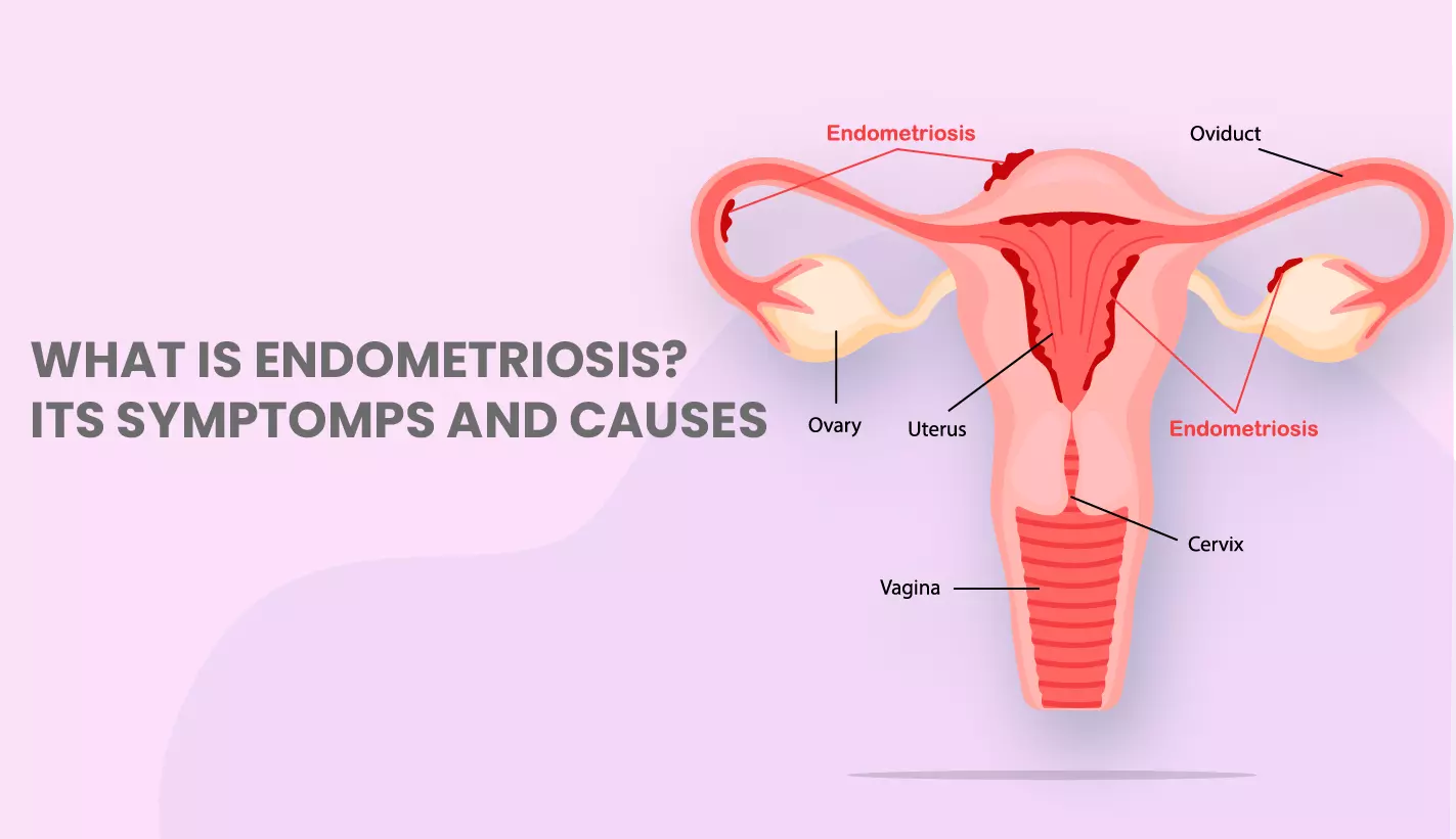 Endometriosis and Abnormal Bleeding — The Center for Endometriosis