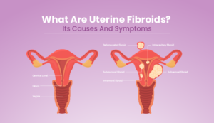 uterine fibroids Its causes and symptoms
