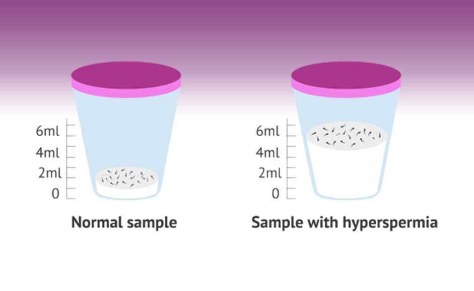 hyperspermia