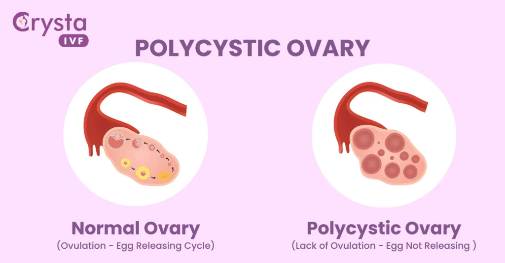 Normal vs polycystic ovary