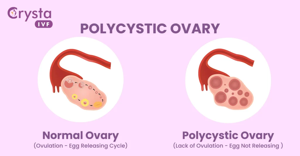 How to get pregnant with ovarian cysts?