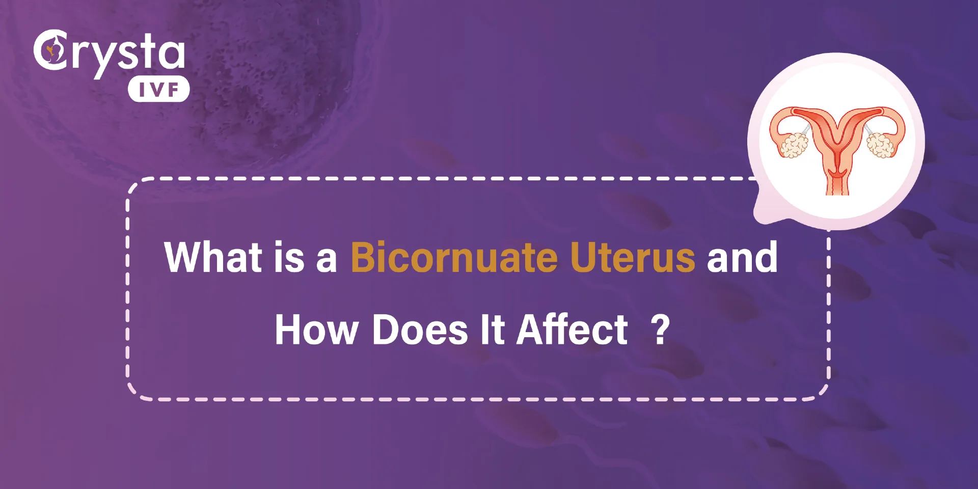 What Is a Bicornuate Uterus