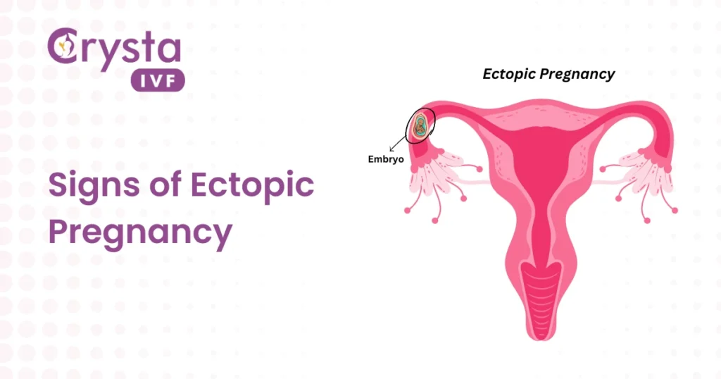 symptoms of ectopic pregnancy