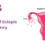 symptoms of ectopic pregnancy