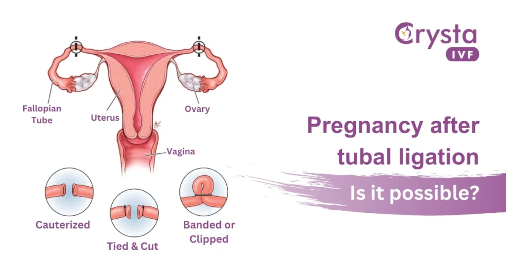 tubal ligation