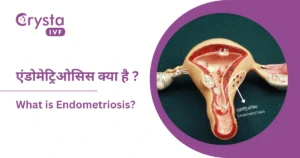 एंडोमेट्रियोसिस क्या है - Endometriosis Meaning in Hindi