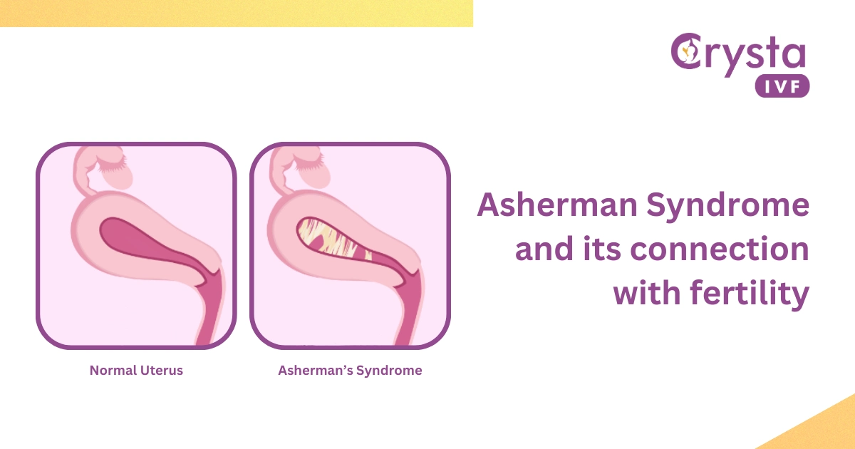 Asherman Syndrome and its connection with fertility