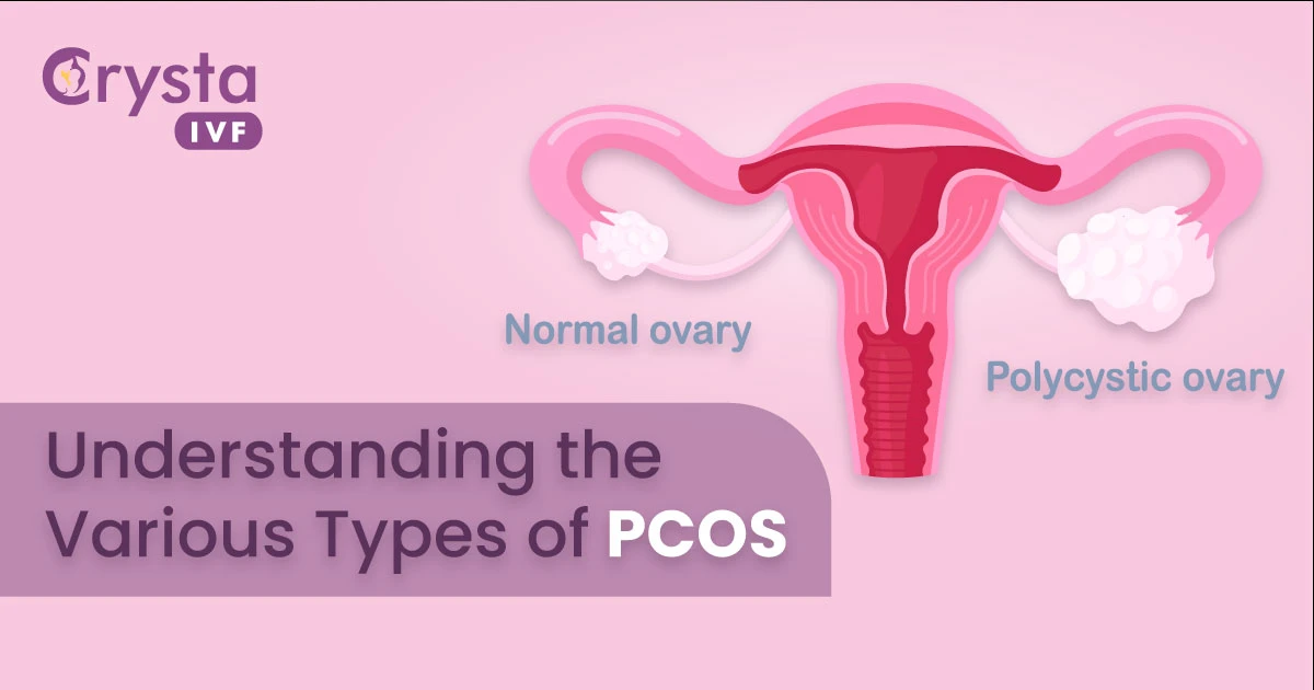 types of pcos