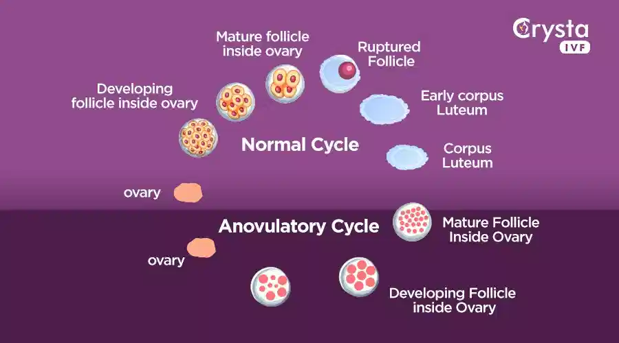 Normal Cycle vs Anovulatory Cycle