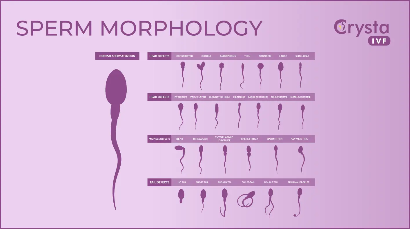 Sperm-Morphology Guide With Sperm Defects Related to Head, Tail or Mid Defects Visuals